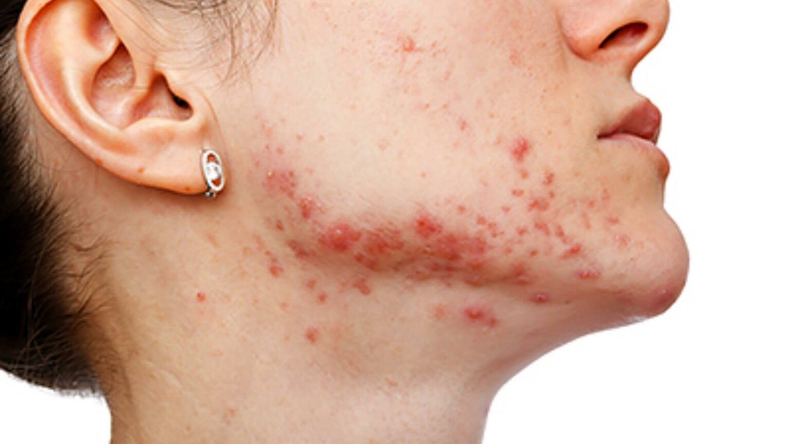 acne-conglobata